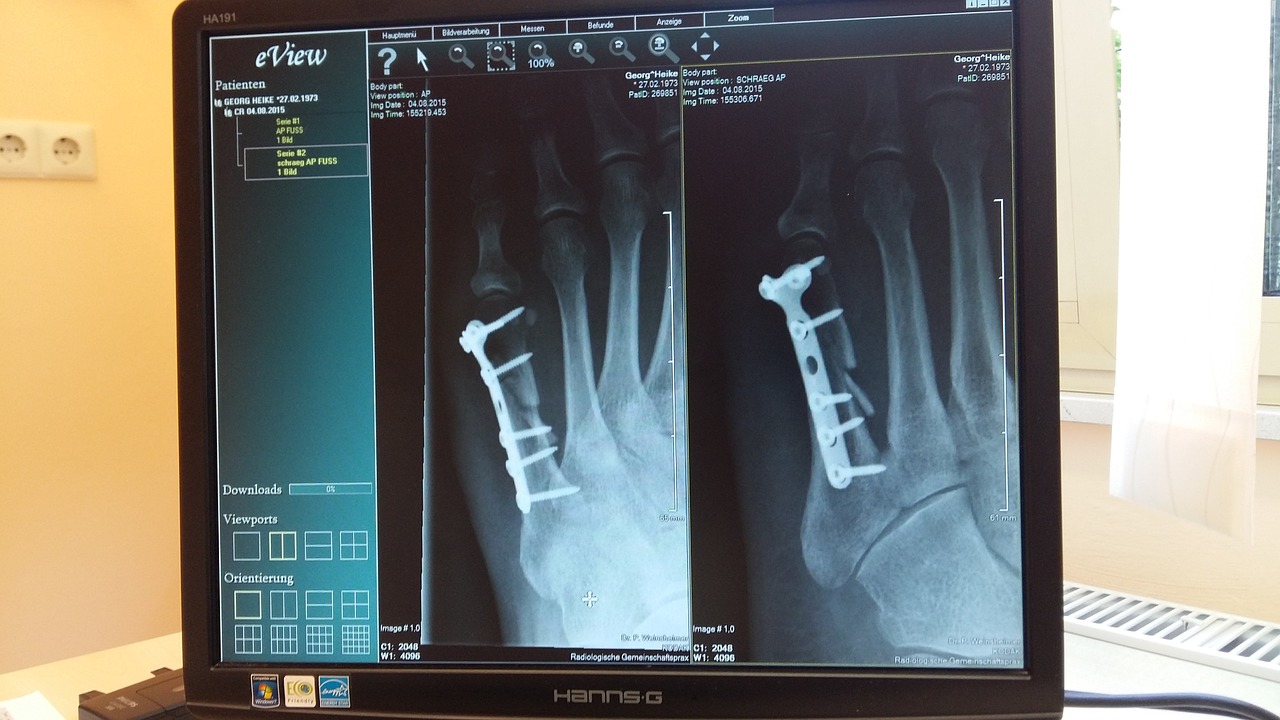 fracture